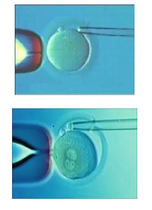 杭州试管婴儿详细步骤